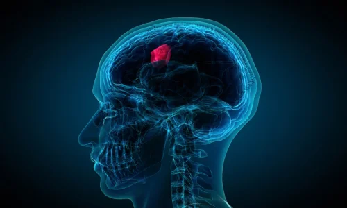 Brain Tumors & CNS Lesions