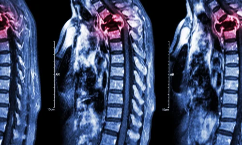 Thoracic Cancers